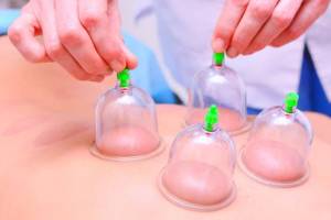 Medical cupping